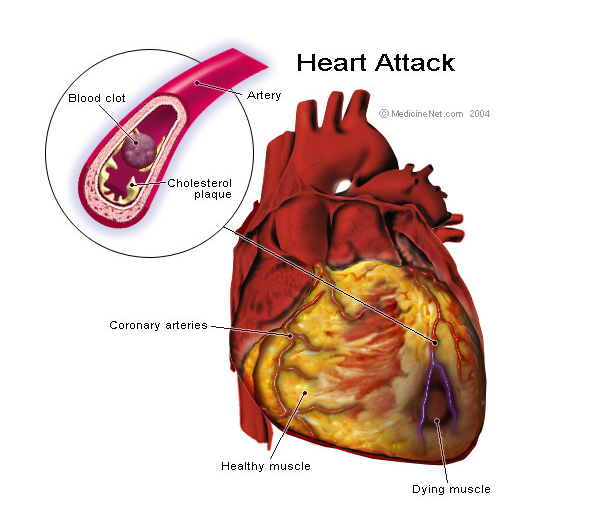 heart attack. Symptoms Of Heart Attack…